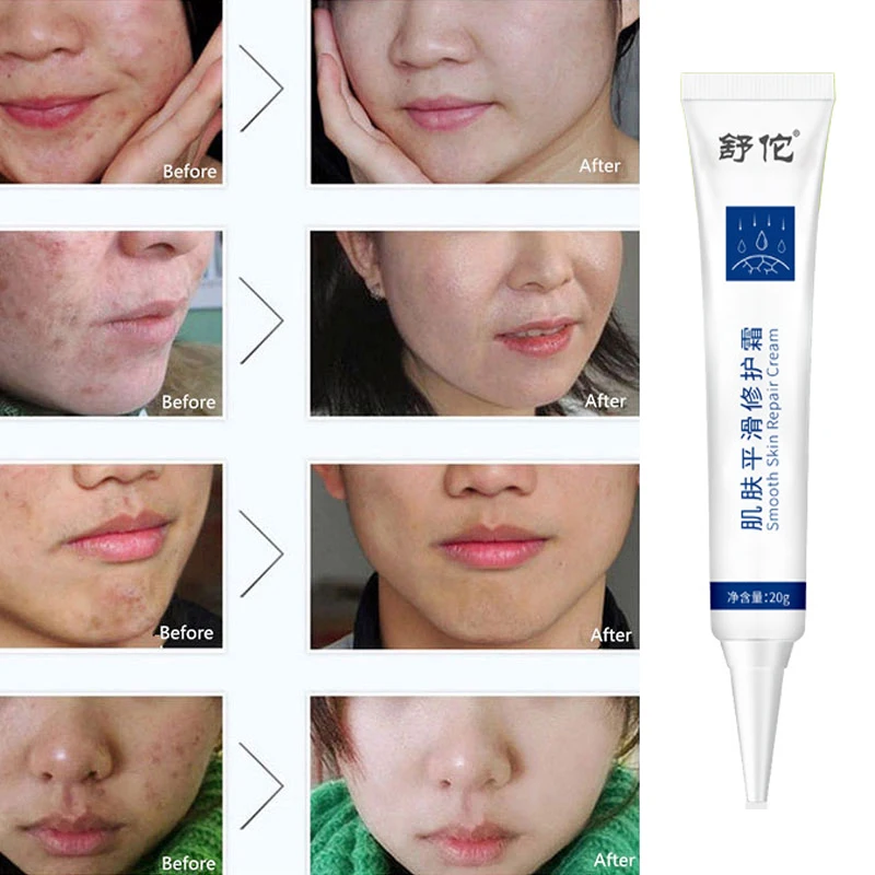 

Skin smoothing and repairing cream is refreshing, mild, and fade scar and acne marks. Skin repairing and acne removing gel