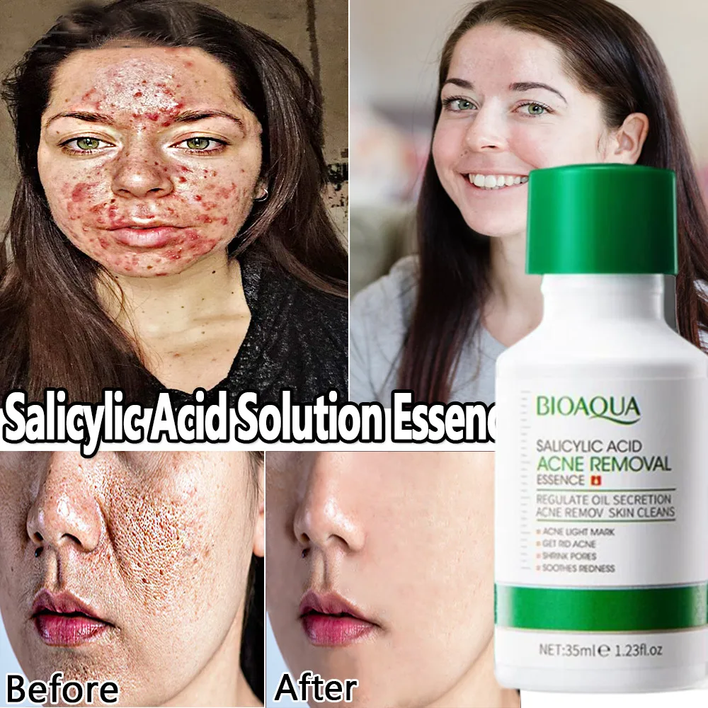 

35ML Salicylic Acid Solution Essence Shrink Pores Acne Removal Oil Treatment Acne Scar Spots Whitening Moisturizing Face Oil