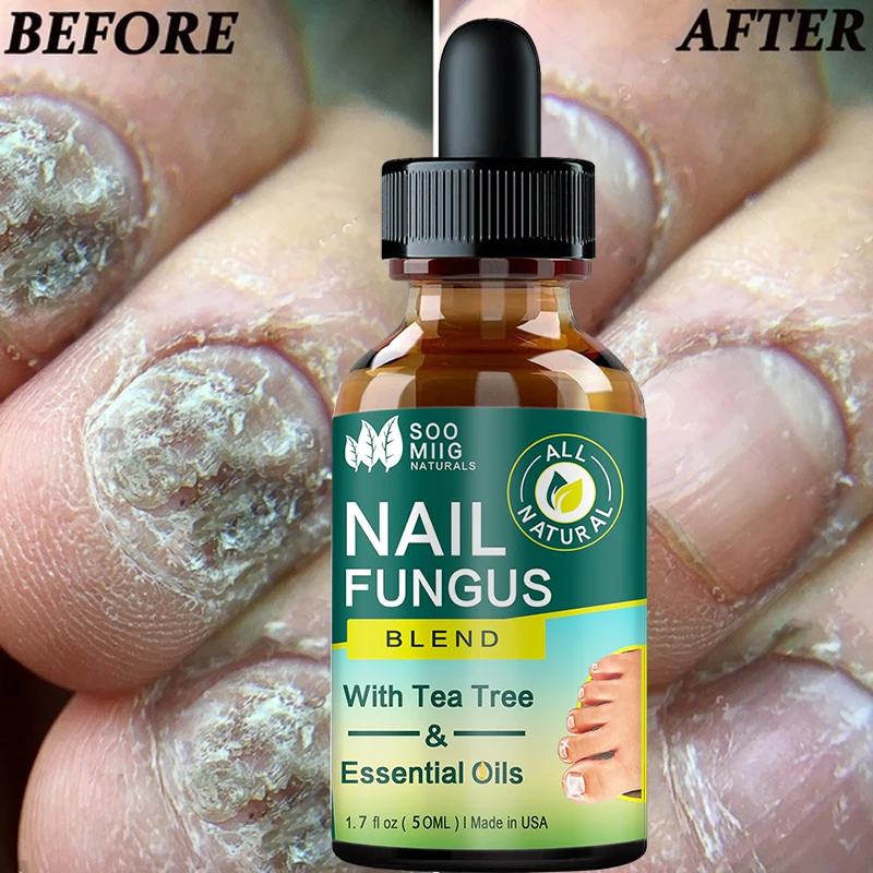 

Nail Fungus Treatment Serum Anti-Infective Onychomycosis Onychomycosis Hand Care Nail Foot Fungus Removal Gel