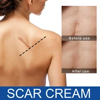desalt scar repair cream scald burn old scar acne mark operation scar smooth skin scar repair desalt cream skin repair cream