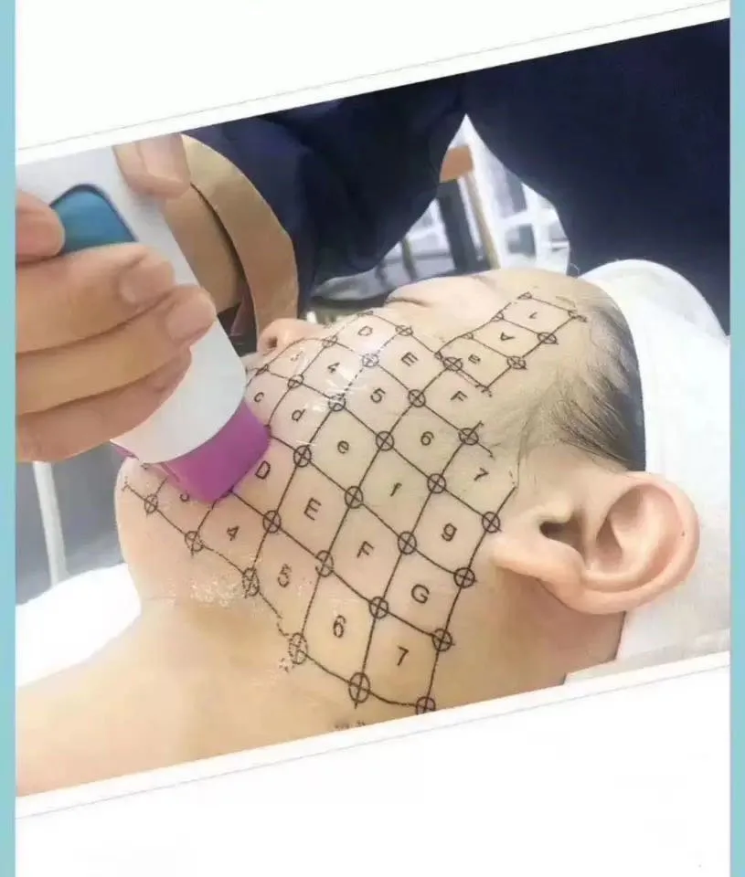 

Beauty Fractional Radio Frequency RF Machine Accessory Graph Paper