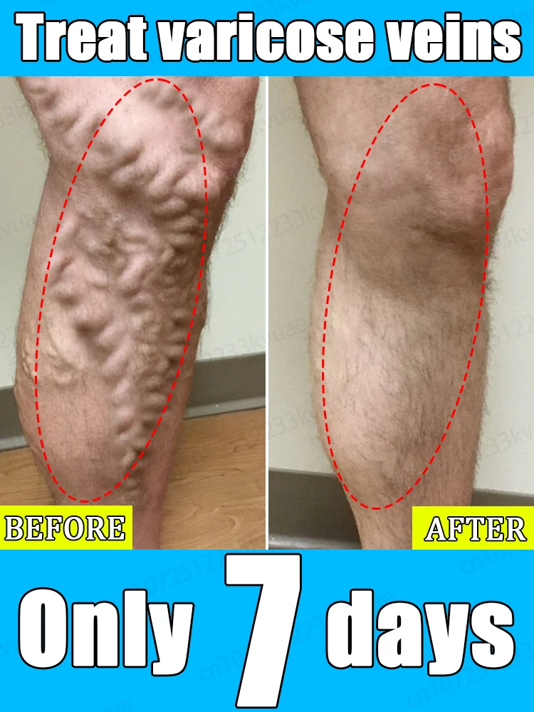 Мазь от варикозного расширения вен 7-дневное лечение опухших кровеносных сосудов