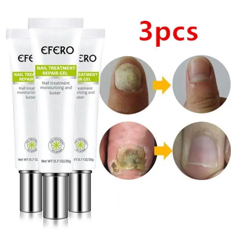 

3PCS EFERO Fungal Nail Serum Repair Essence Foot Nail Fungus Removal Gel Anti Infection Paronychia Onychomycosis Nail Treatment