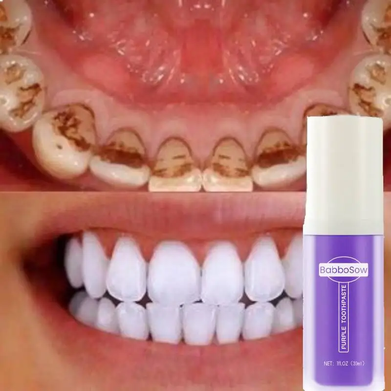 

Ортопедическая зубная паста V34, средство для удаления пятен от глубокого дыма, защита Gingiva, Эффективная очистка, осветление полости рта
