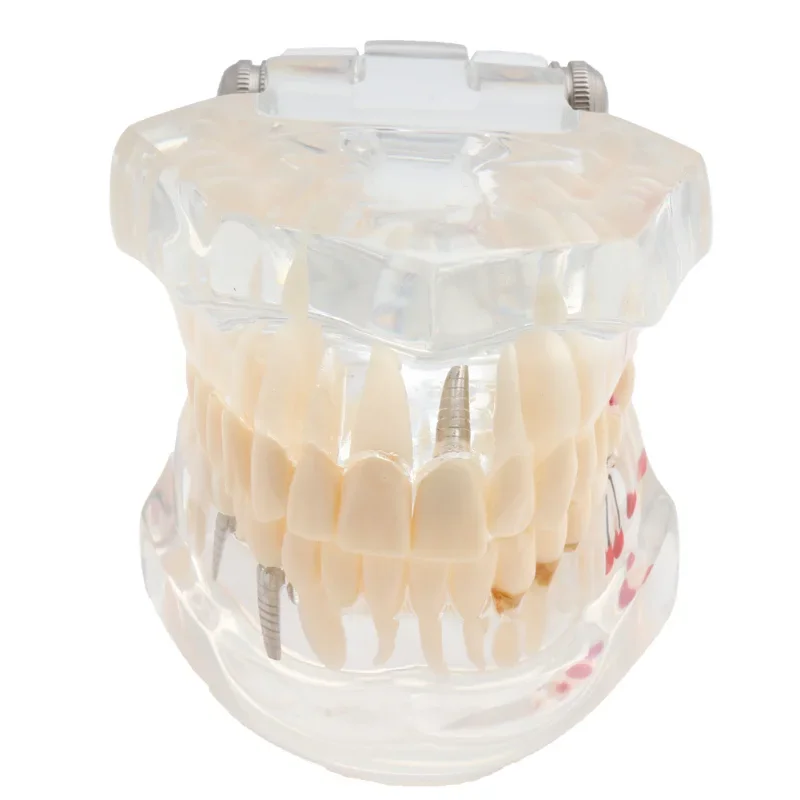 

New Dental Model Teeth Implant Restoration Bridge Teaching Study Medical Science Disease Dentist Dentistry Products