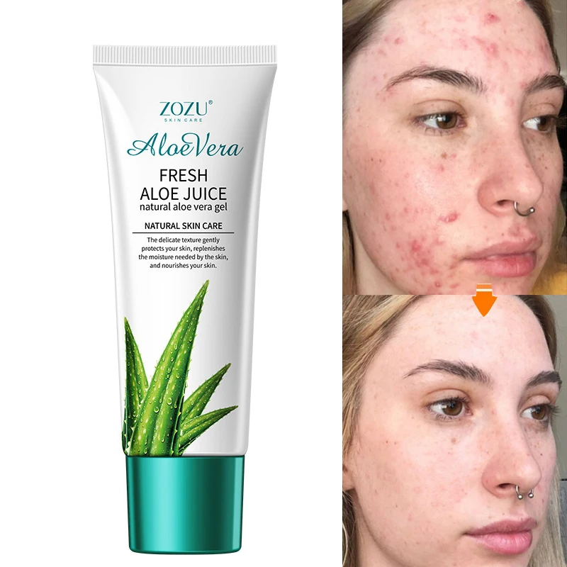 

Aloe Vera Gel Acne Removal Spots Burn Cream Surgical Scar Treatment Whitening Moisturizing Soothing Facial Skin Care Products