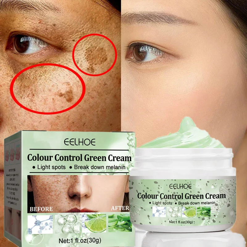 

Effective Whitening Freckles Face Cream Remove Dark Spots Melasma Fade Acne Scars Melanin Brighten Moisturizer Skin Care Product