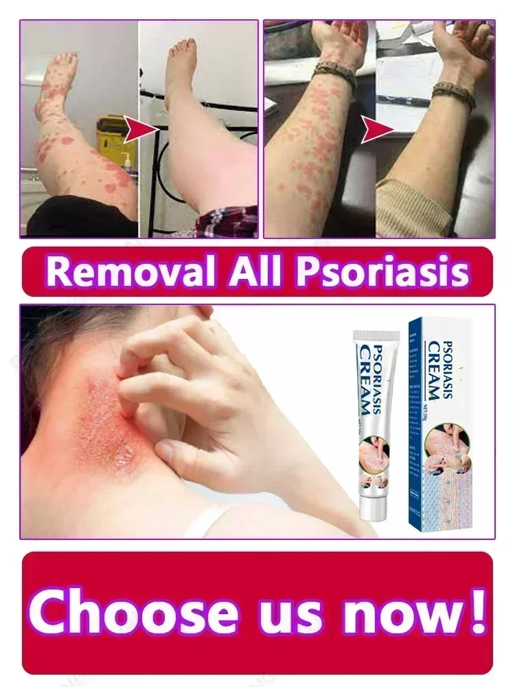 Устройство для избавления от псориаза лучше всего использовать в соответствии с
