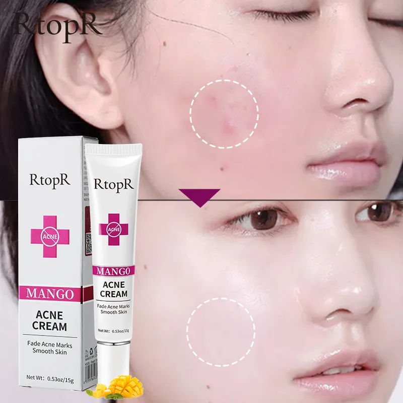 

Skin Scar Removal Cream Face Fade Scars Cream Acne Spots Acne Treatment Blackhead Whitening Cream Anti Scar Stretch Marks Beauty