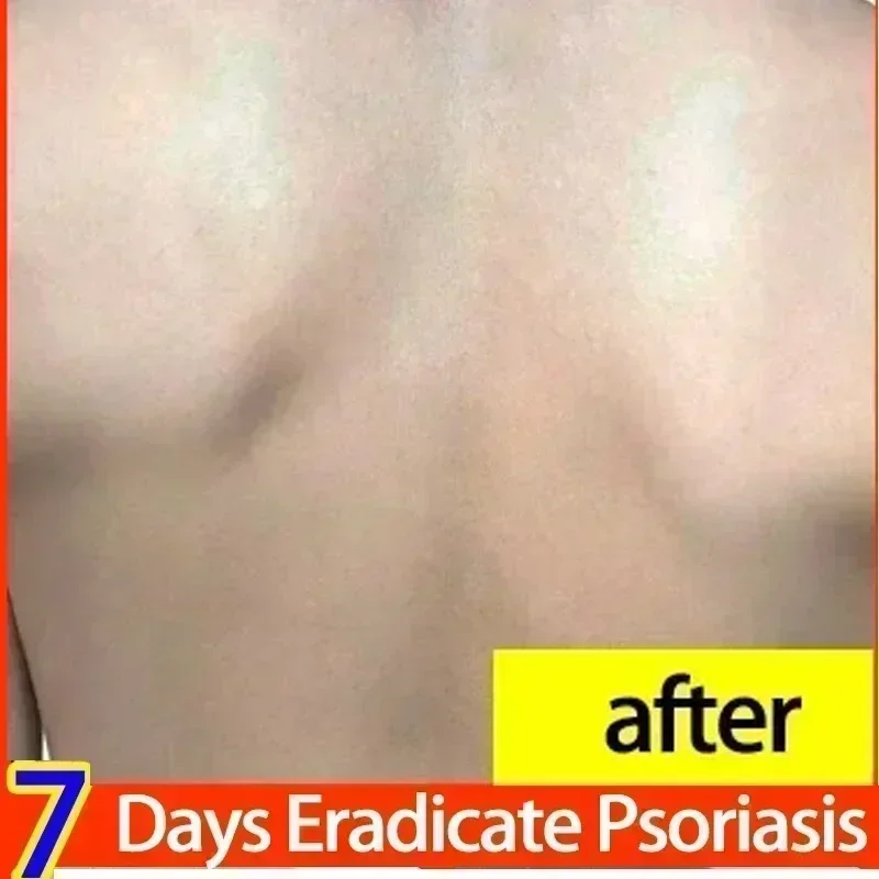 Лечение короткого псориаза мох специальная мазь для лекарств псориаз тела и
