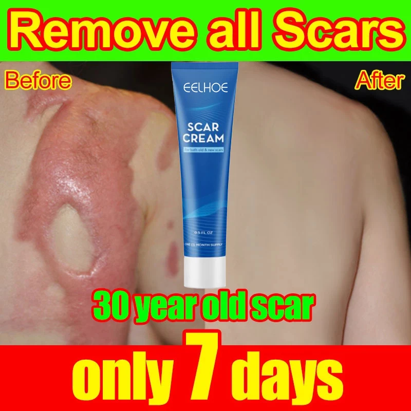 

Scar Removal Cream Repairing Pock Mark Burn Surgical Scar Cesarean Scar Stretch Mark Treatment Smooth Moisturize Skin Care 30g