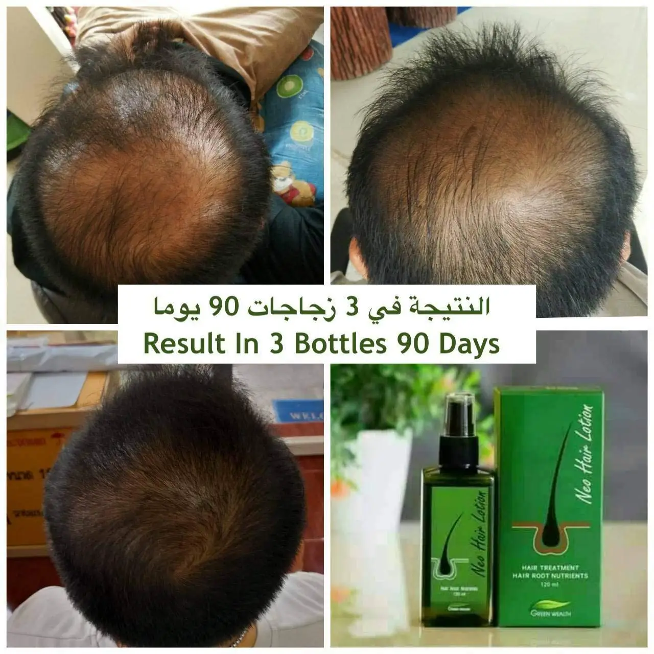 Neo Hair Lotion Herbs 100% Natural Treatment Spray Stop Loss Root BEARD SIDEBURNS LONGER Nutrients +Gift roller | Красота и здоровье