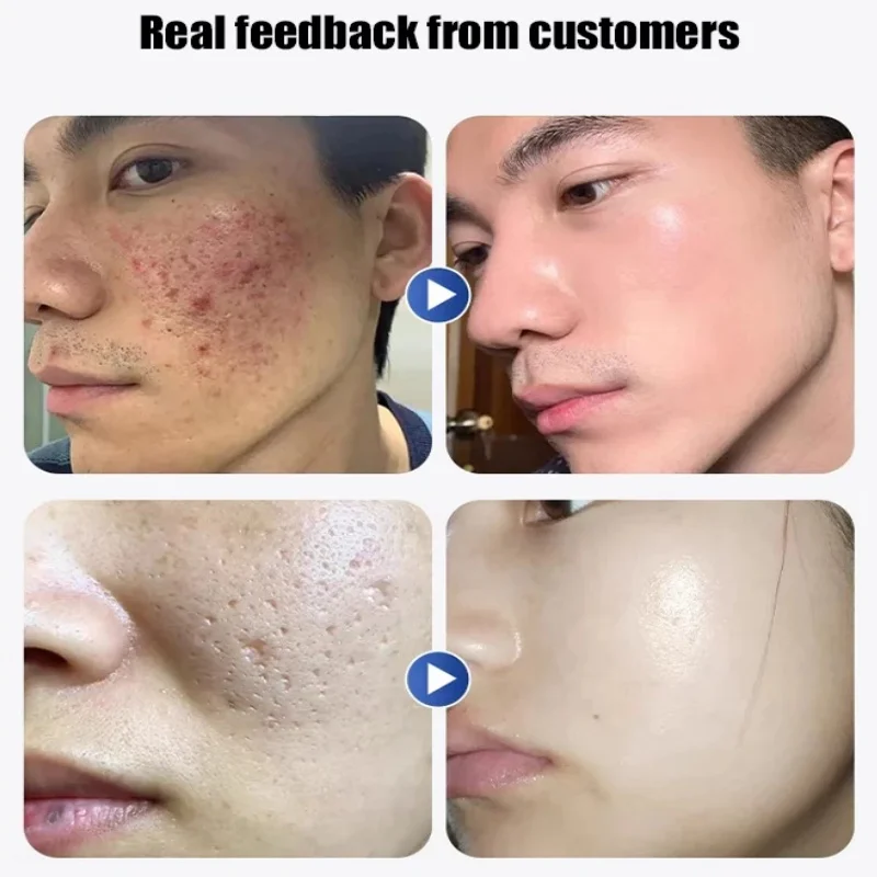 Травяной крем для лица от прыщей гель против лечение шрамов сужение пор