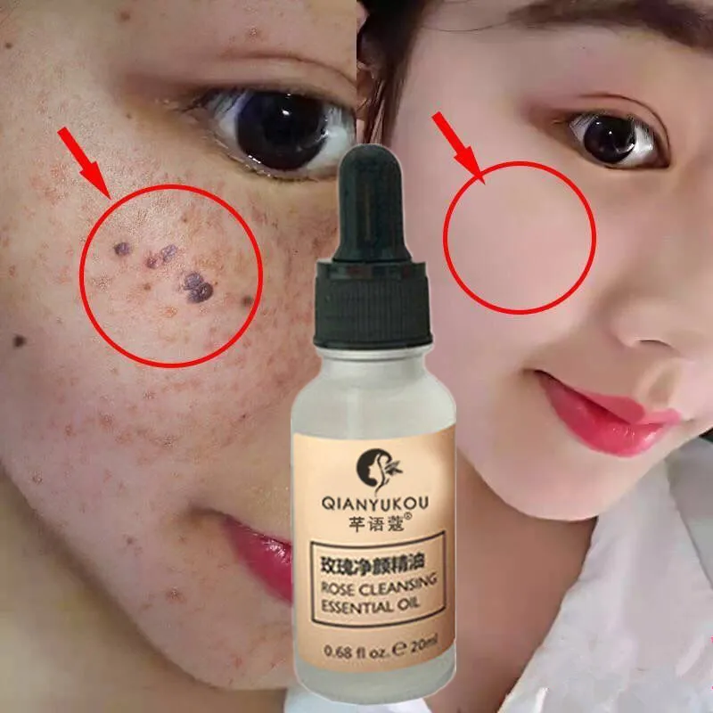 

Rose Essential Oil Removes Black Spots and Reduces Melanin Facial Serum Moisturizing and Lightening Moles Body Care Oil