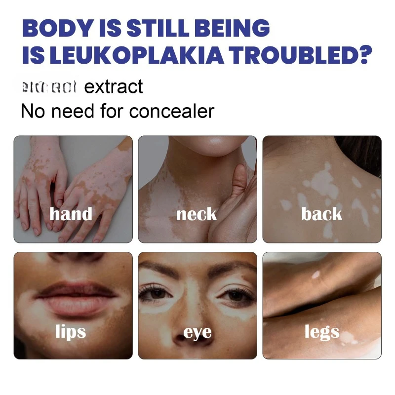 Сыворотка для лечения Vitiligo лампа роста пигмента Ringworm Tinea удаление пота и белых