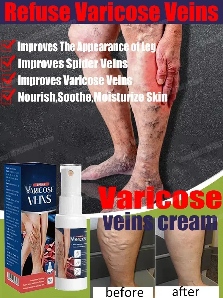 Надежный спрей для варикозного расширения вен натуральные травы успокаивающий с