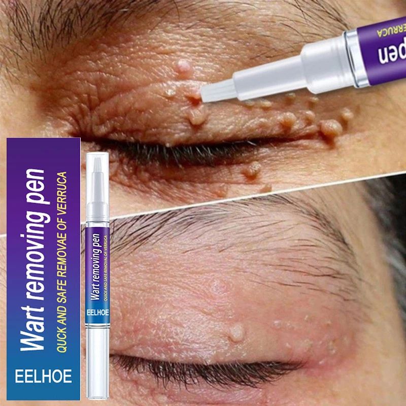 

Skin Tags Remover Liquid Pen Warts Treatment Anti Foot Corn Against Moles Genital Wart Acne Spot 12 Hours Fast Removal Skin Care
