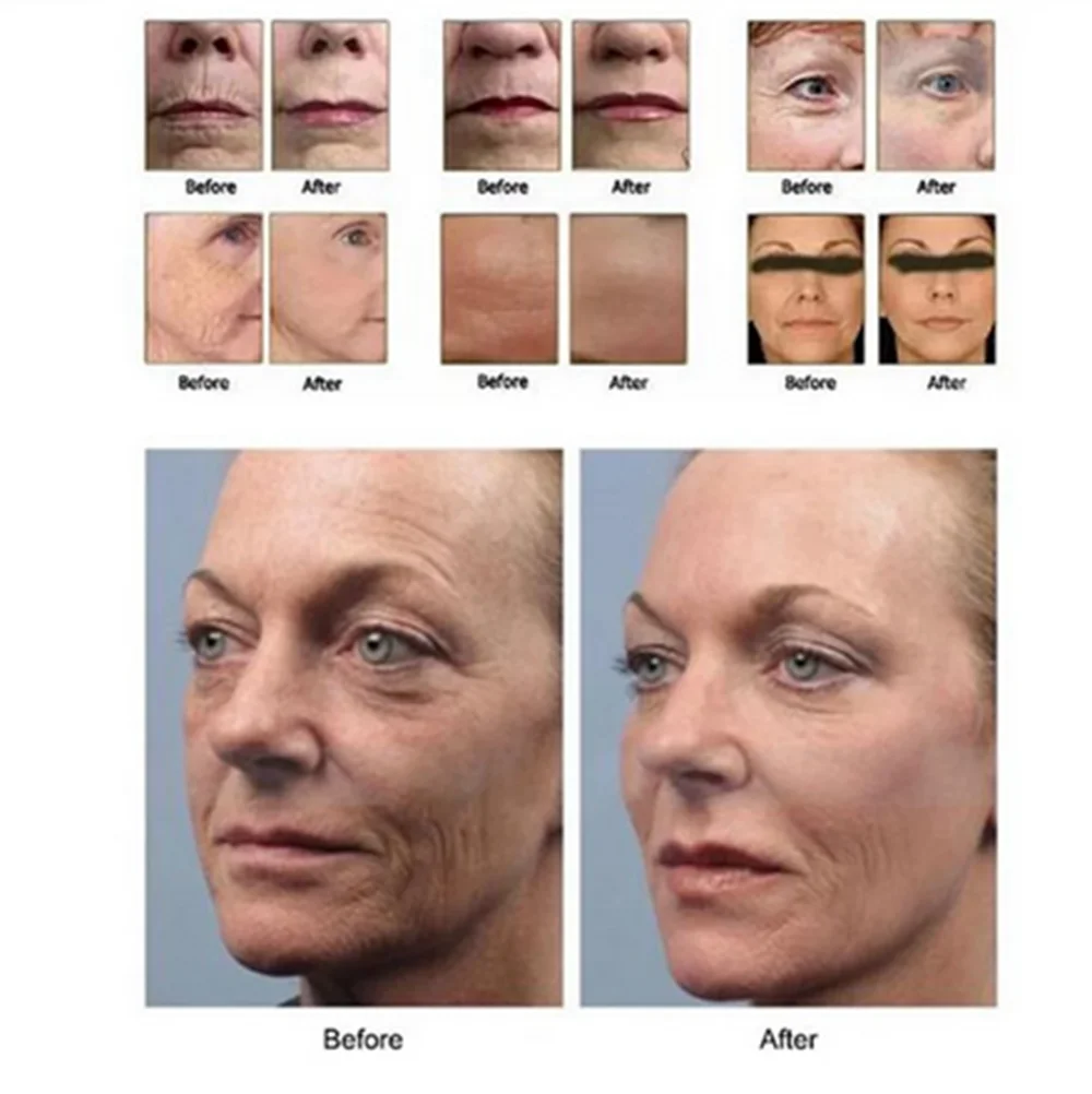 4D 12-линейный HIFU-картридж запасные расходные материалы зонд и ручка для подтяжки