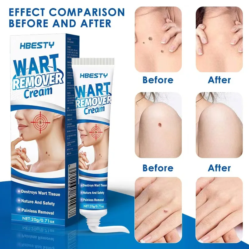 

Warts Remover Liquid Antibacterial Ointment Wart Treatment Cream Skin Tag Remover Herbal Extract Corn Plaster Warts Ointment 20g