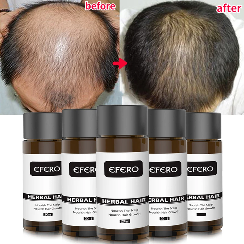 Ginger Hair Growth Essential Oil Serum Treatment Anti Lost Beauty Products Fast Grow Repair Scalp Frizzy Damaged Care |