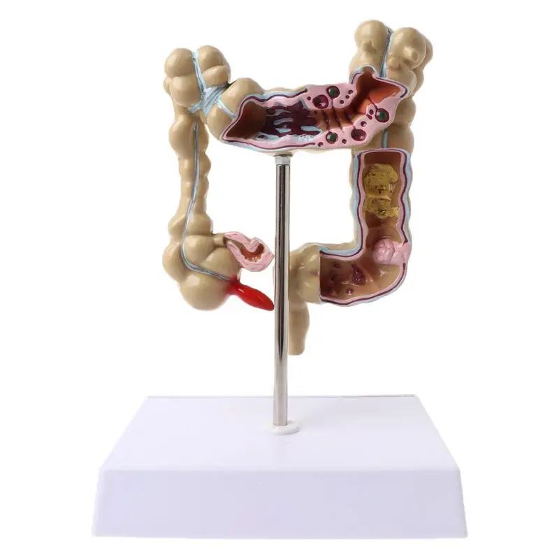 

2022 New Human Colorectal Lesion Model Pathological Anatomy Colon Diseases Intestine Medical Teaching Learning Tool