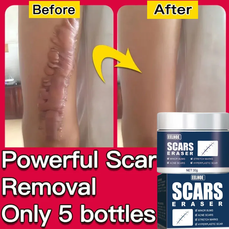 

New Rapid Scar Removal Cream Effective Treatment Stretch Marks Burns Lighten Acne Spots Section Scars Whiten Skin Care Products