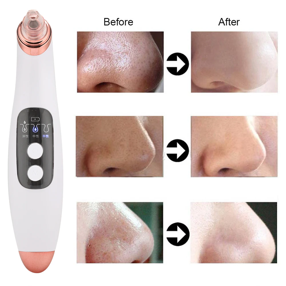 

6 in 1 Electric Pore Cleanser Remove Blackheads Pimples Instrument Facial Cleaning Tool