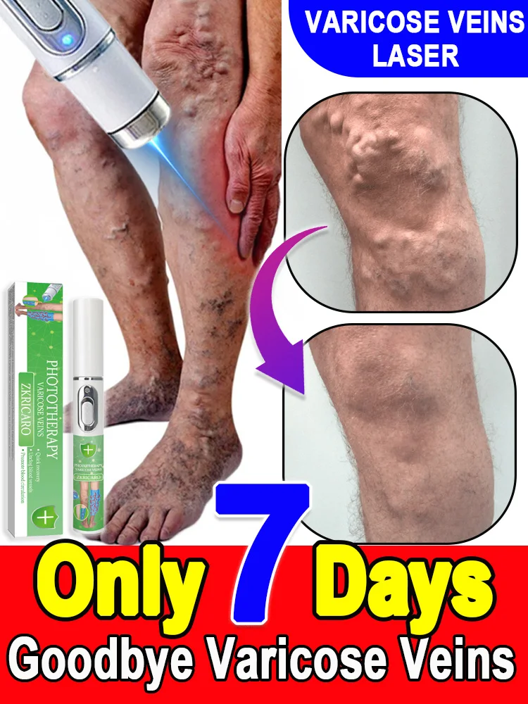 Венозные лазерные продукты постоянно устраняют их Ремонт и лечение варикозного