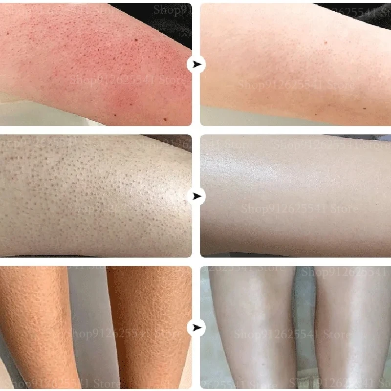 50 г крем для волосяного фолликула и кератоза восстанавливает кожу