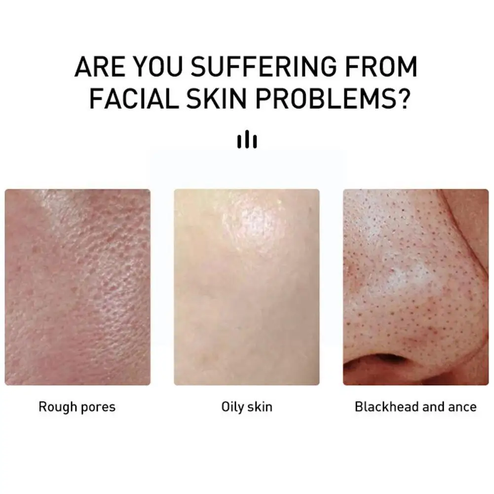 

15ml Salicylic Acid Acne Cream Fight Black Spots Remedy Marker Acid Repair Cream Salicylic Acne Pimple E3x4