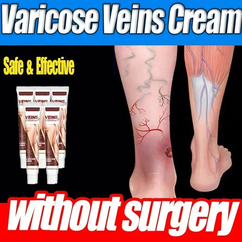 Мазь от варикозного расширения вен эффективный крем для облегчения ...