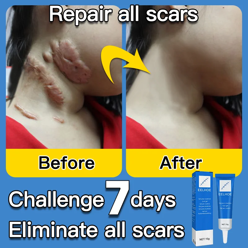 

Scar Removal Cream Gel Remove Acne Spots Treatment Stretch Marks Burn Surgical Scar Repair Cream Smoothing Whitening Skin Beauty