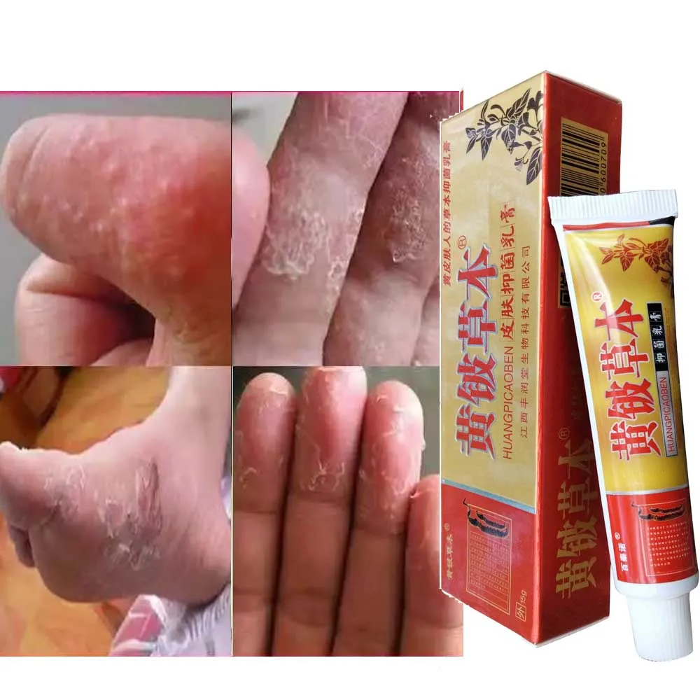 

Fungal vesicle Antibacterial Cream Psoriasis Herbal Treatment Eczema Anti-itch Relief Rash Urticaria Desquamation Ointment