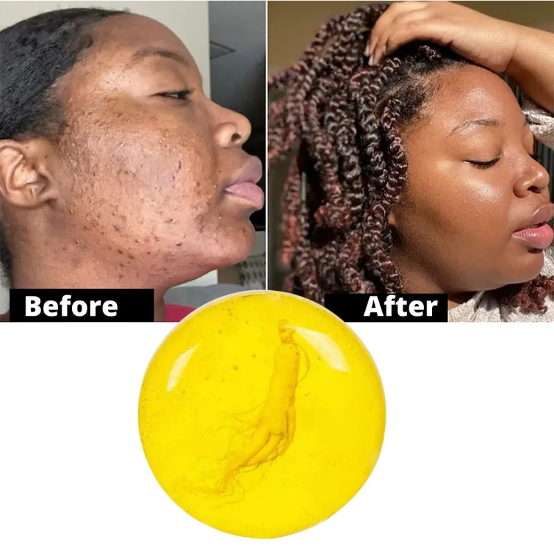 Добавьте акне прыщи пятна шрамы корректор темных пятен афроамериканское мыло