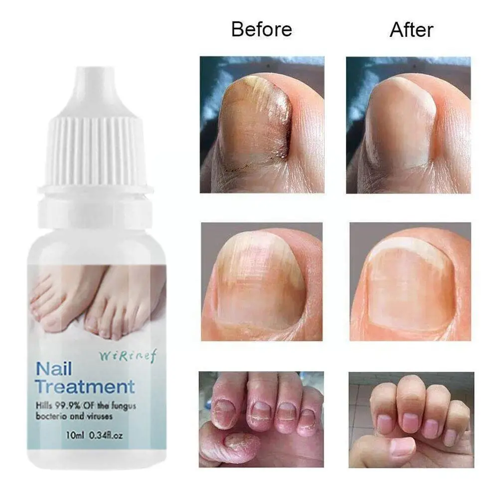 

10 мл Сыворотка для лечения грибка ногтей восстанавливающая эссенция для ног крем и уход против инфекции грибка для ногтей гель для рук и ног L8O8