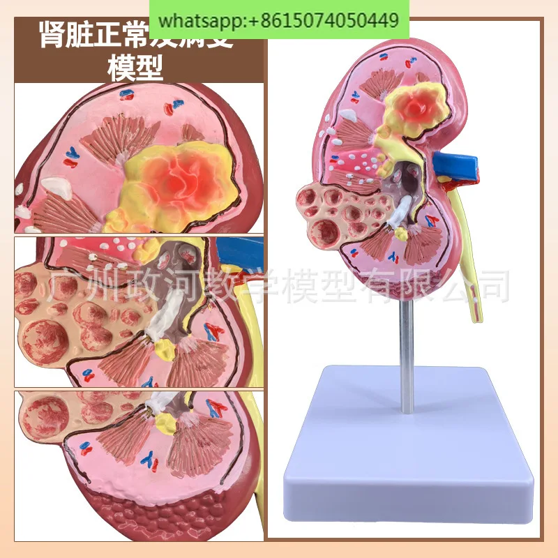 Моделирование обучения модель патологической почки образец почечной анатомии