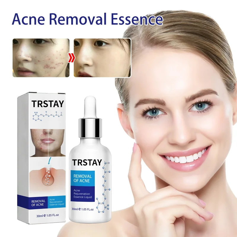 

Acne Treatment Serum Oil Control Shrink Pores Whelk Skin Care Face Scar Repair Remove Blackheads Moisturizing Anti Acne Essence