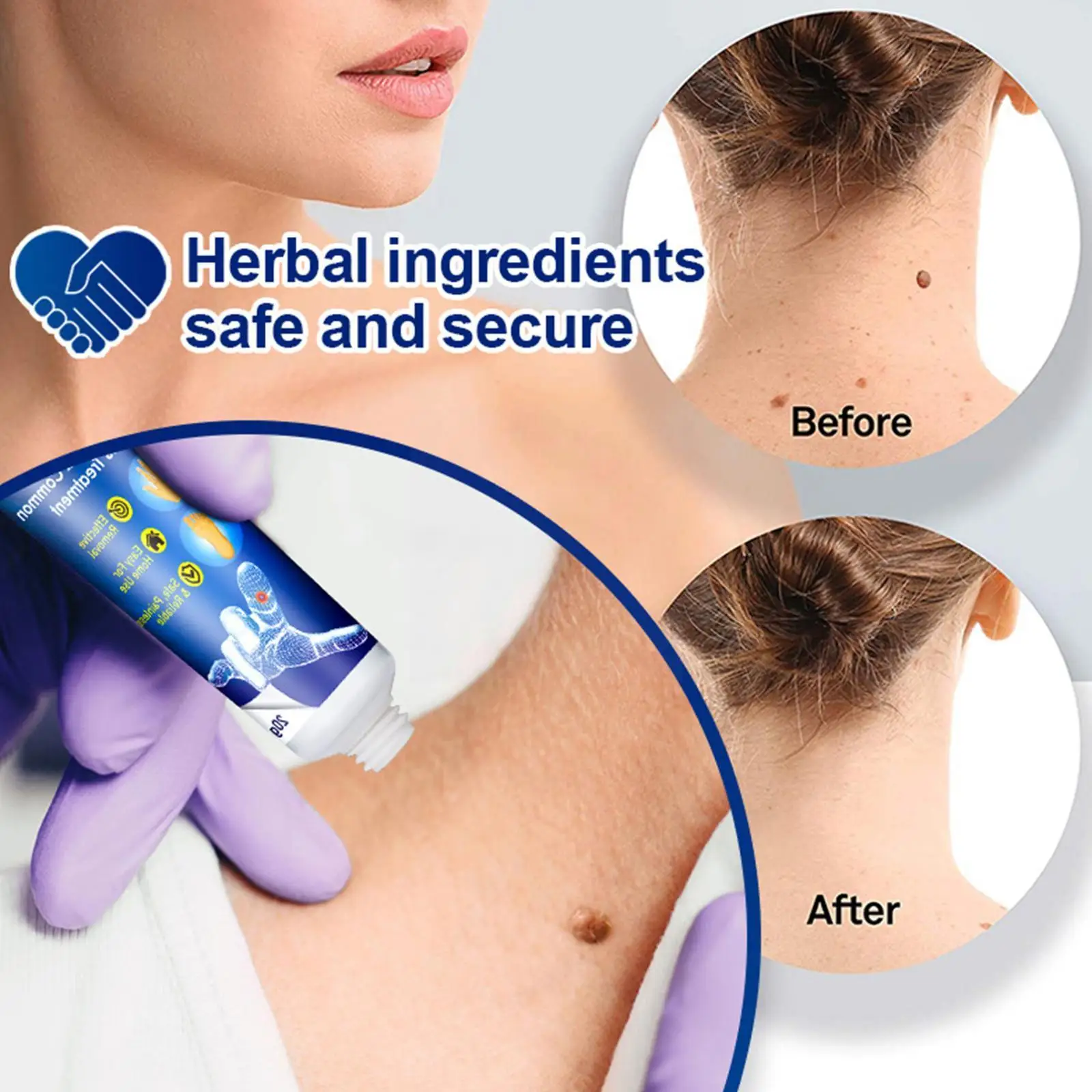 

20G Wart Removal Ointment Wart Treatment Cream Neck Wart Wart Armpit Genitals Flat Wart Corns Feet Medical Cream Skin Tag
