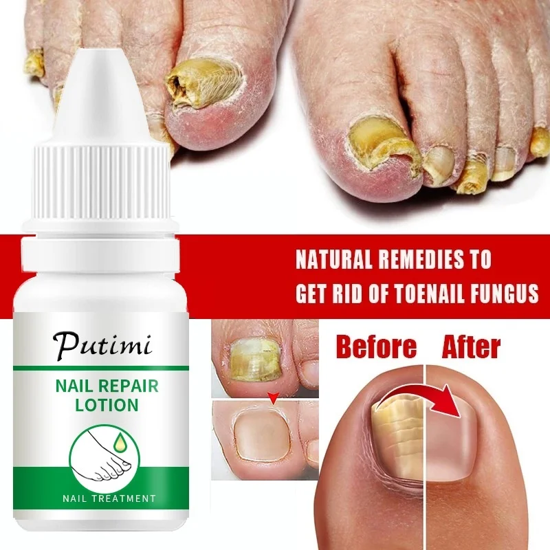 Fungal Nail Treatment Essence Feet Care Serum Anti Infection Paronychia Onychomycosis Nail Foot Toe Nail Fungus Removal Products