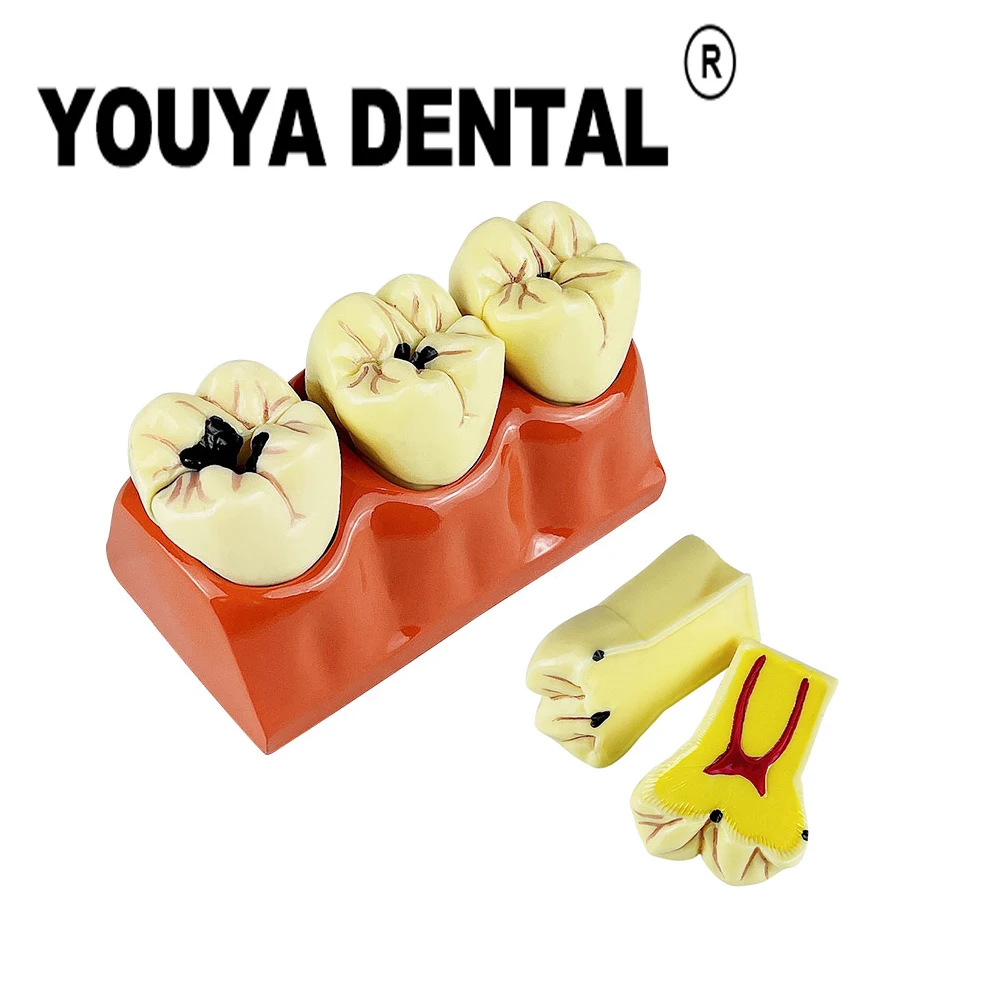 

4 Times Caries Developing Teaching Model For Dentist Student Demonstration Module Medical Science Disease Practice Model