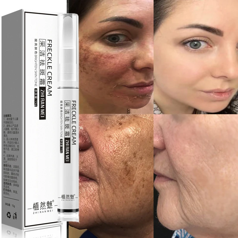 

Отбеливающий крем для веснушек, удаление мелазмы, осветление темных точек, Удаление меланина, увлажнение, уход за лицом, 10 шт.