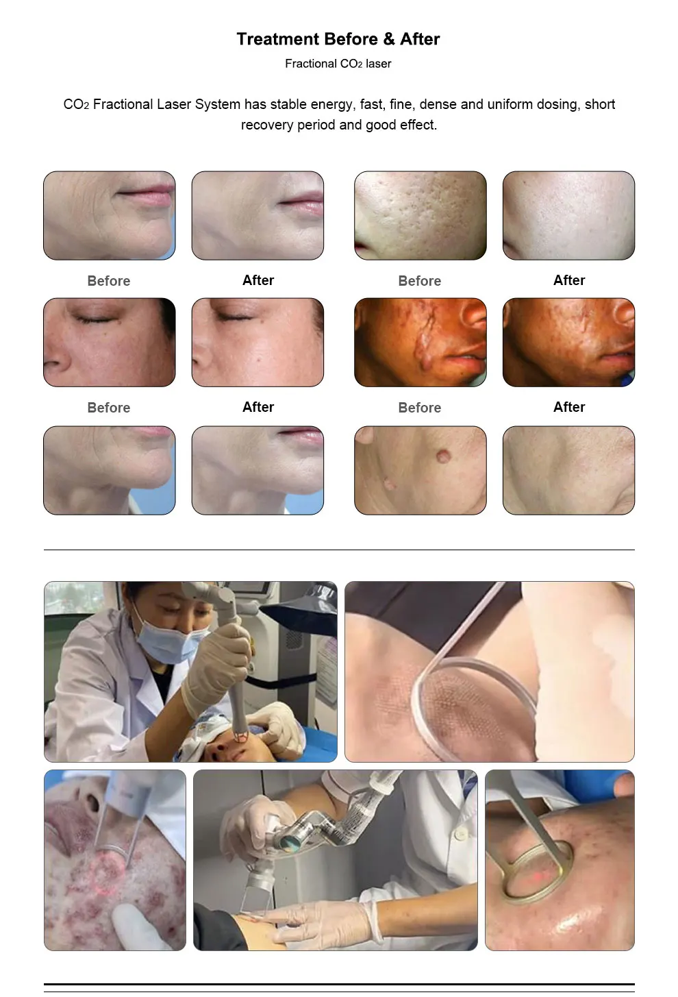 L aser C02 Co2 Фракционный Cosmo Pulse Ultrapulse Fraxis In Dermatology Low Cost Geb Mäd Kaufen