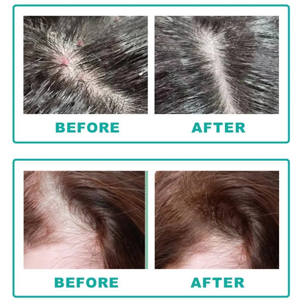 Organic Anti-Dandruff Hair Oil Scalp Treatment Anti-Dandruff Exfoliating Preventing Anti Hair Loss Hair Care Products For Women