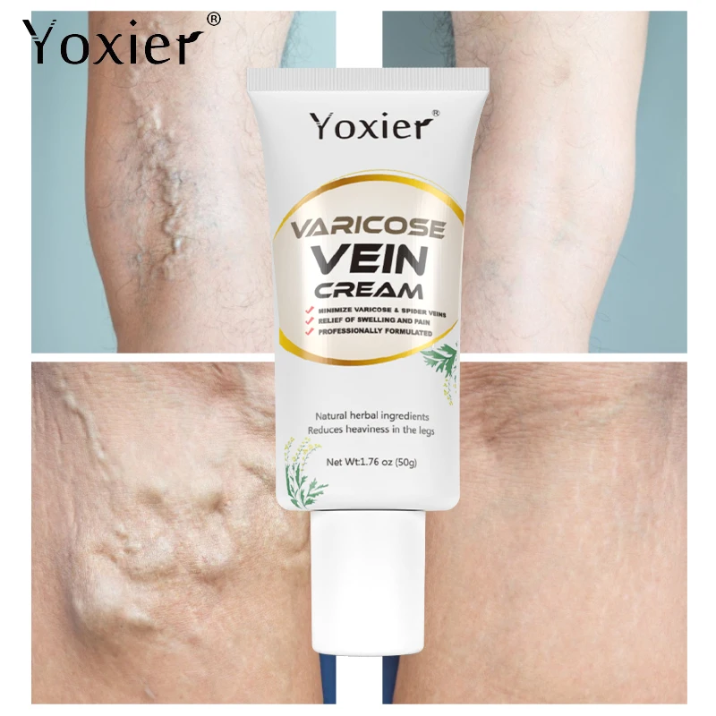 

Varicose Vein Cream Improve Vasculitis Phlebitis Spider Leg Pain Relief Promote Blood Circulation Reduce Swelling Body Care 50g