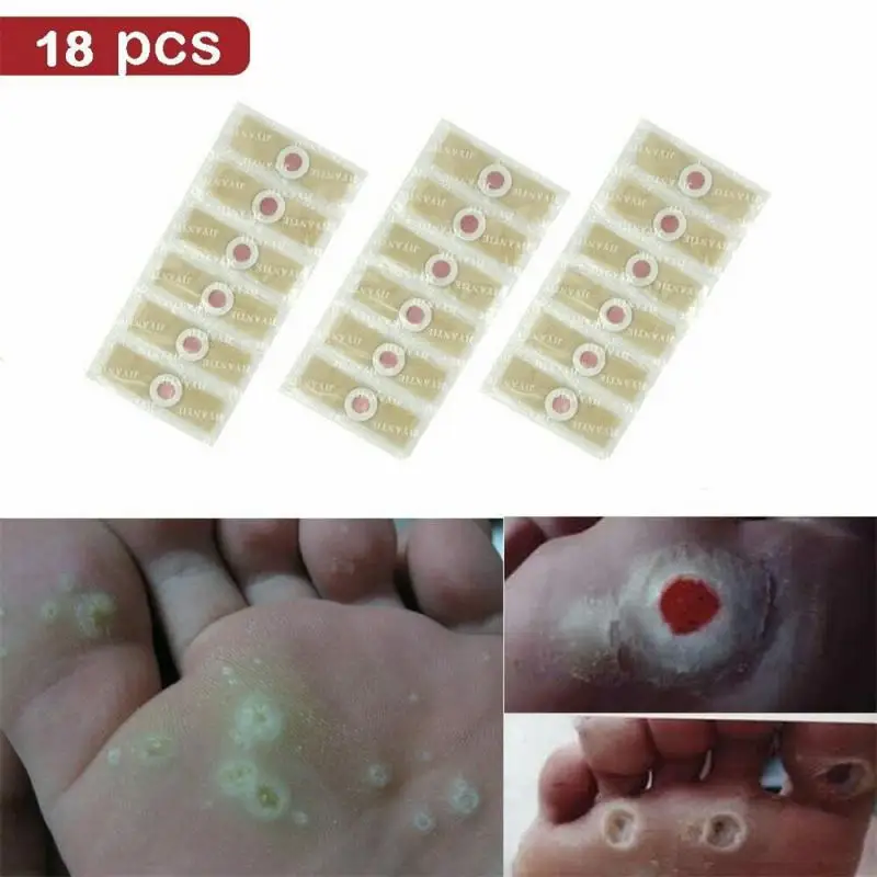 Высококачественный крем для куриных глаз простой в использовании устраняет