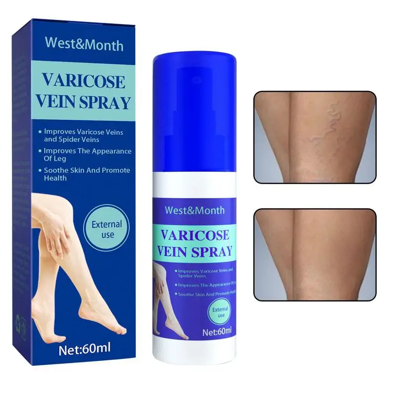 

Varicose Vein Spray 60ml Varicose Vein Care Massage Spray Relieves Phlebitis & Angiitis Inflammation Blood Veins Spider Veins