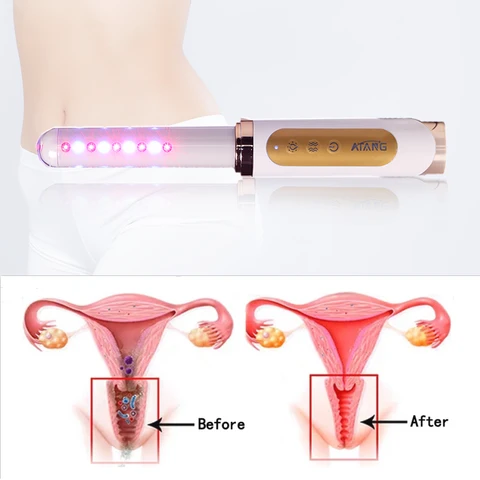 Реабилитационное оборудование для девственной инфекции, холодный лазер, вагинальная палочка для укрепления здоровья женщин, лечение эрозии для домашнего использования