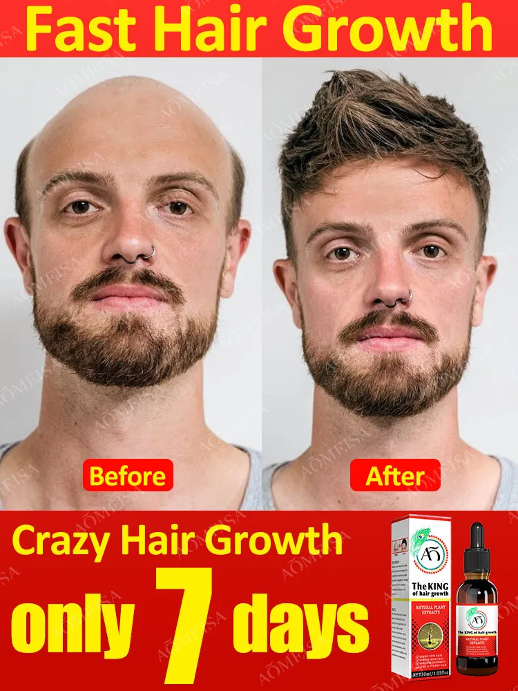 

Масло для роста волос, эффективное средство для быстрого роста волос в течение семи дней для восстановления и выпадения волос, Послеродовая потеря волос, себорреевая алопеция