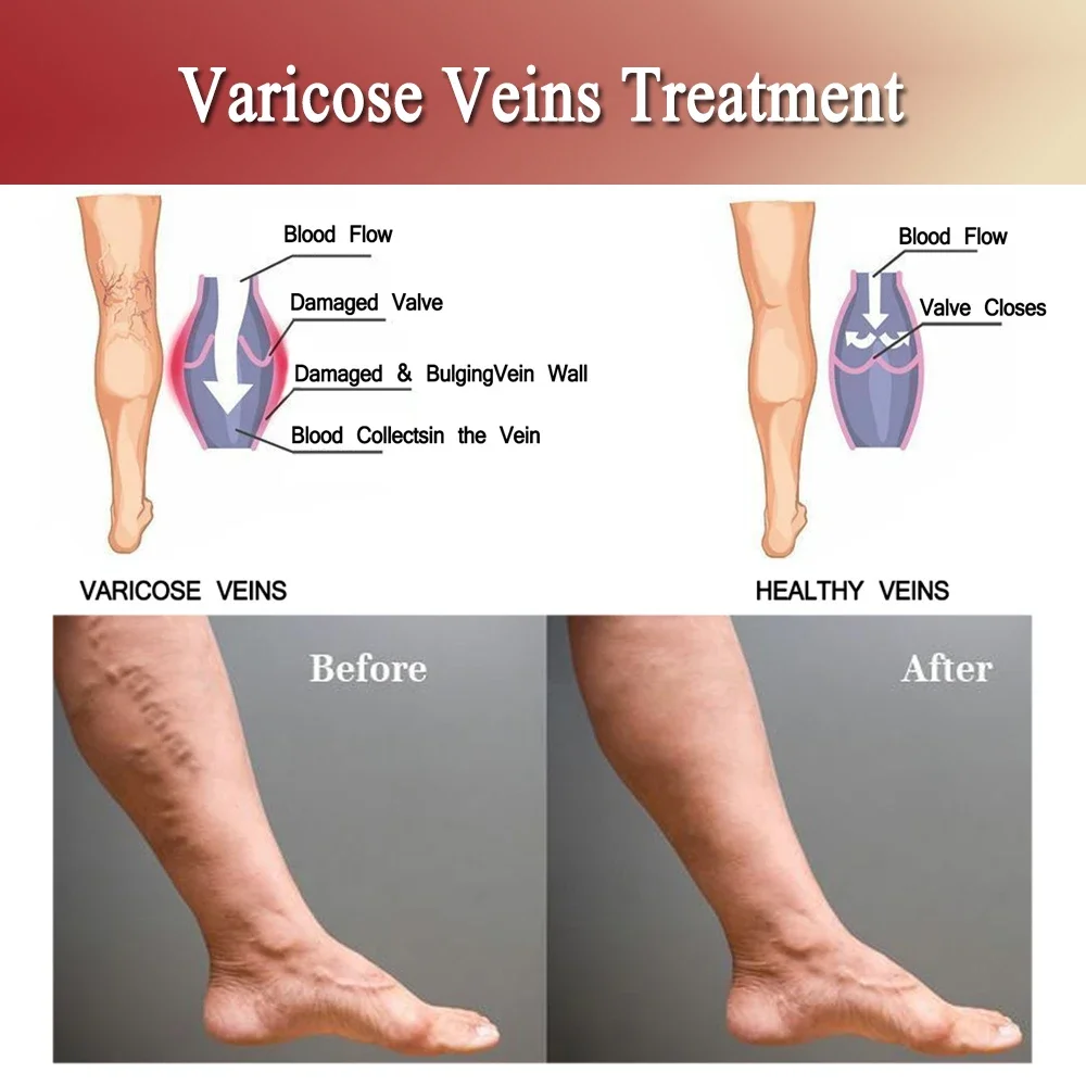 Улучшенные пластыри от варикозного расширения вен Jemeesen для улучшения