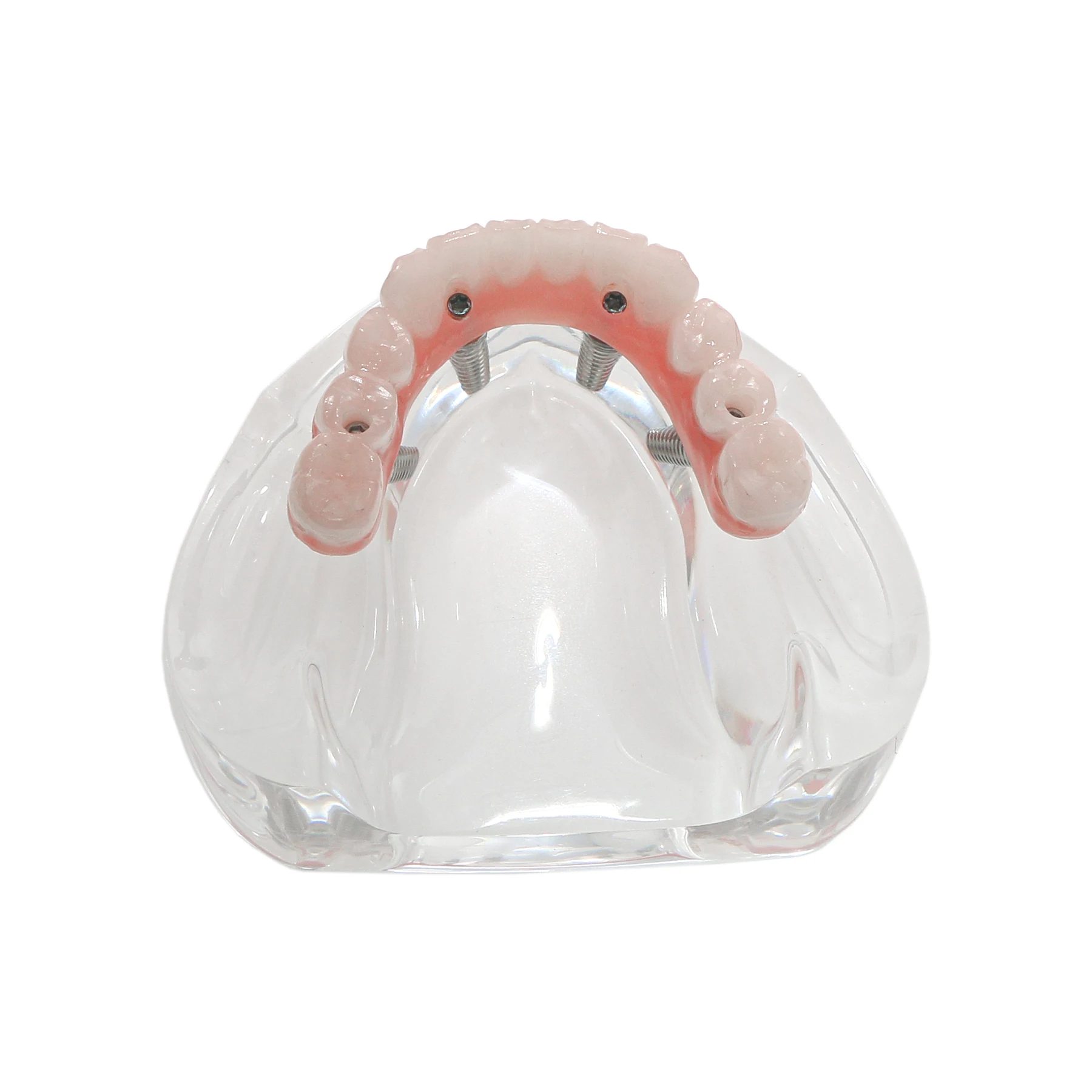 Стоматологическая модель реставрации нижнего имплантата 4 съемных винта с